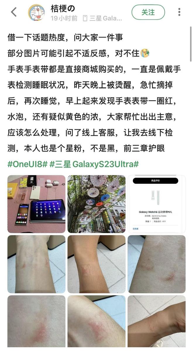 要选对材质佩戴方式也很重要智能手表导致皮肤红肿？不光(图1)